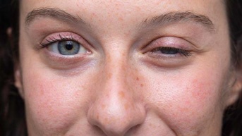 Enfermedad Miastenia Gravis (Internet)