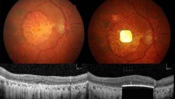 Una nueva prótesis ocular ha logrado devolver la visión a personas con ceguera irreversible a consecuencia de una atrofia geográfica, la última etapa de una forma de degeneración macular asociada a la edad (DMAE), que afecta, aproximadamente a 5 millones de personas en el mundo. Se trata de un dispositivo compuesto por dos partes, un microchip inalámbrico que se implanta en la parte posterior del ojo y unas gafas de realidad aumentada. En la imagen puede verse el microchip insertado en el ojo. (EFE)