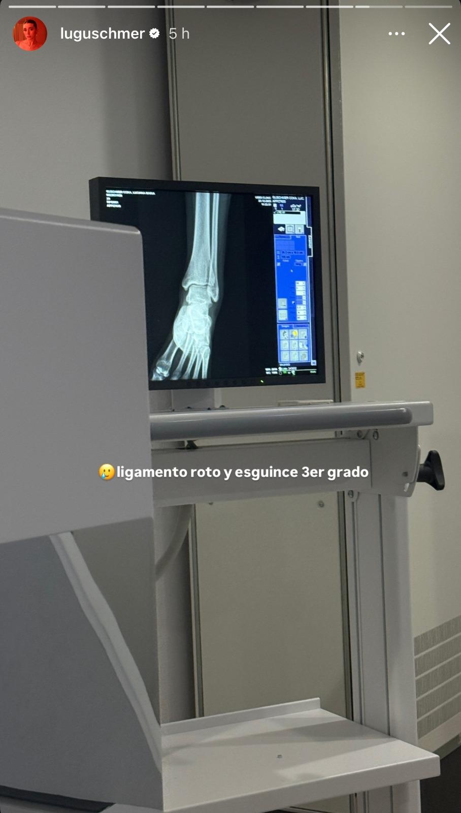 Storie de Luciana mostrando su esguince.  (Captura de Pantalla)