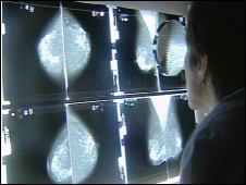 Una nueva investigación encontró los ocho síntomas más estrechamente vinculados al cáncer.