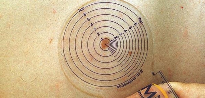 Tener lunares puede ser un factor de riesgo de cáncer de piel pero es importante saber que la mayoría son benignos.