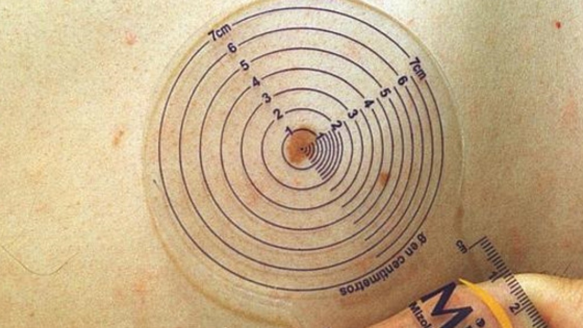 Tener lunares puede ser un factor de riesgo de cáncer de piel pero es importante saber que la mayoría son benignos.