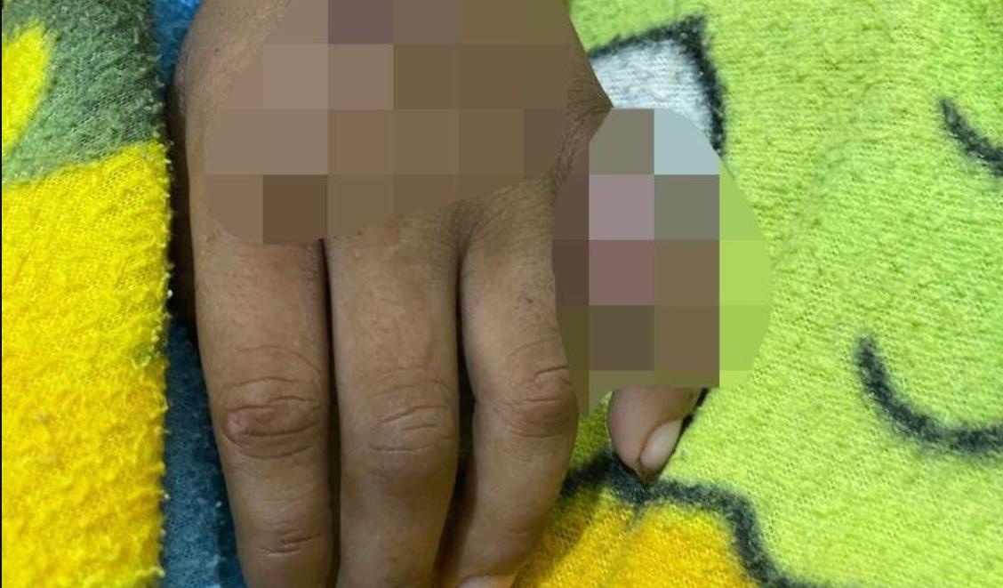 El niño continúa en estado crítico, en un hospital infantil de Guayaquil, y ya fue operado por octava ocasión.