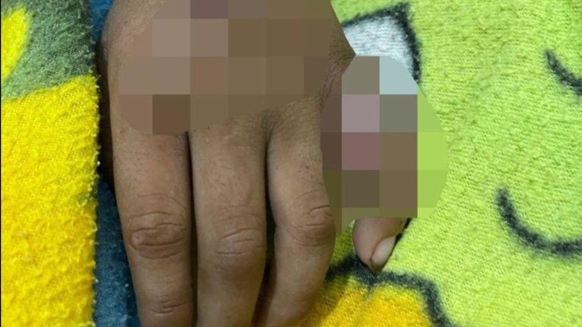 El niño continúa en estado crítico, en un hospital infantil de Guayaquil, y ya fue operado por octava ocasión.