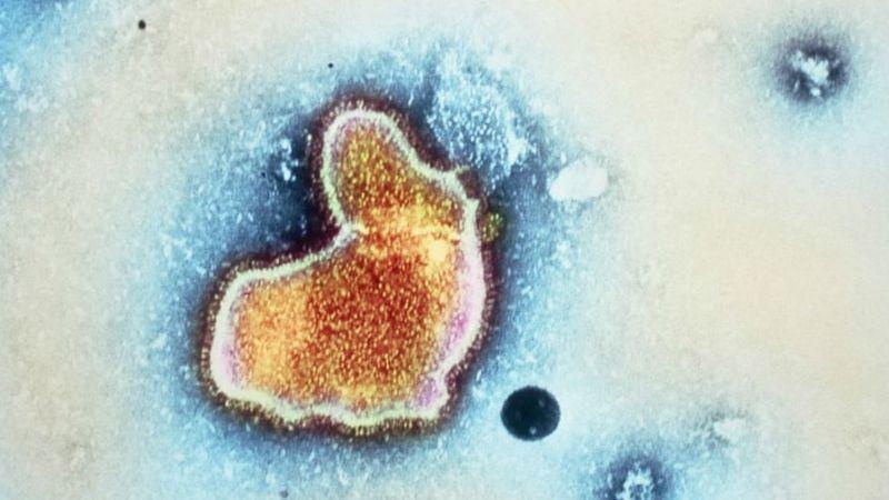 Imagen del Virus Respiratorio Sincitial o VRS. "Sincitial" se refiere a que el virus destruye membranas celulares por lo que se forman masas con numerosos núcleos celulares llamadas "sincicios". (GETTY IMAGES)