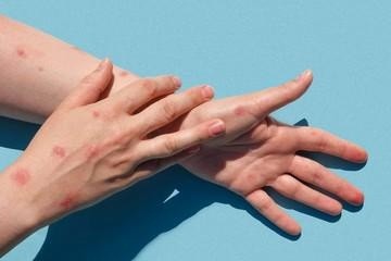 Imagen referencial de los síntomas de la viruela del mono. (Internet)