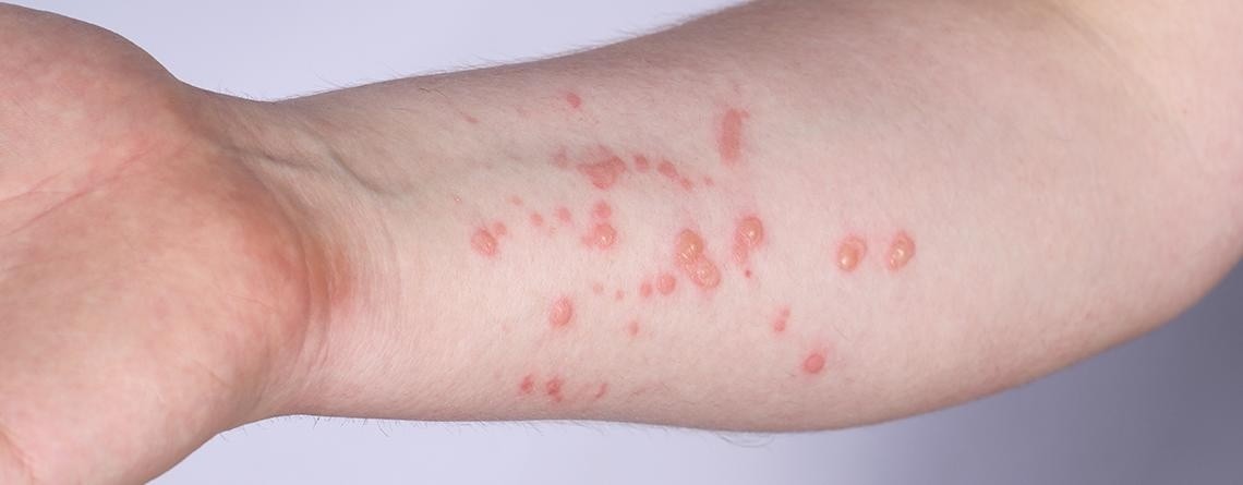 Imagen referencial de una persona con signos de viruela del mono en su cuerpo. (Medcentro)