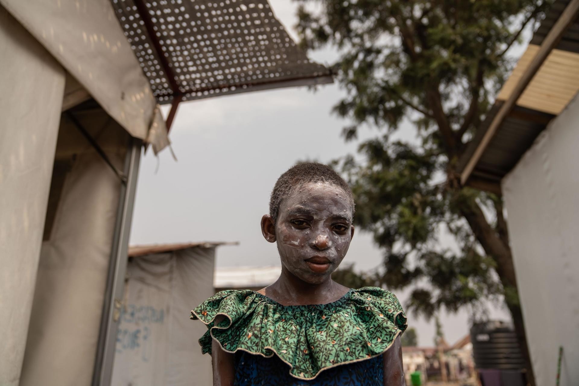 Lucie Habimana, de 13 años, tiene la cara cubierta con ungüento después de recibir tratamiento para el mpox en el Centro de Salud Munigi en Munigi, República Democrática del Congo, el 16 de agosto de 2024. (MOISE KASEREKA / EFE)