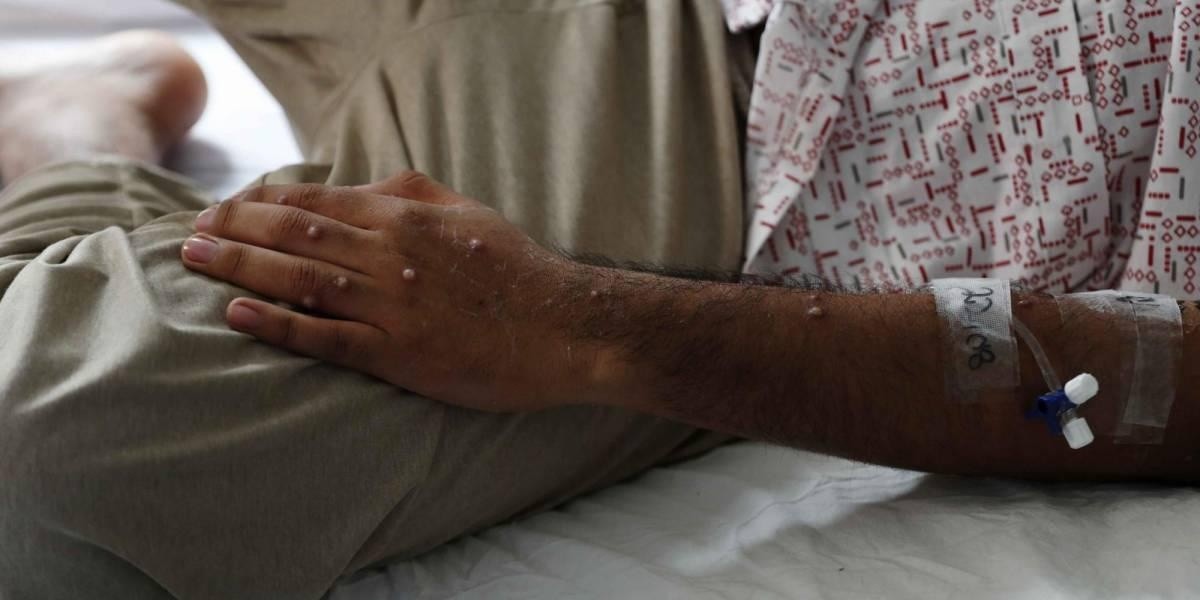 Paciente atendido tras contagiarse de la MPOX. (EFE)