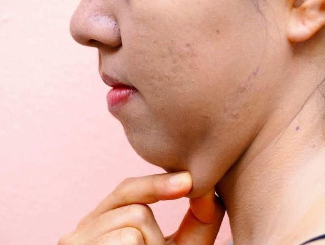 Papada mujer. Wikipedia