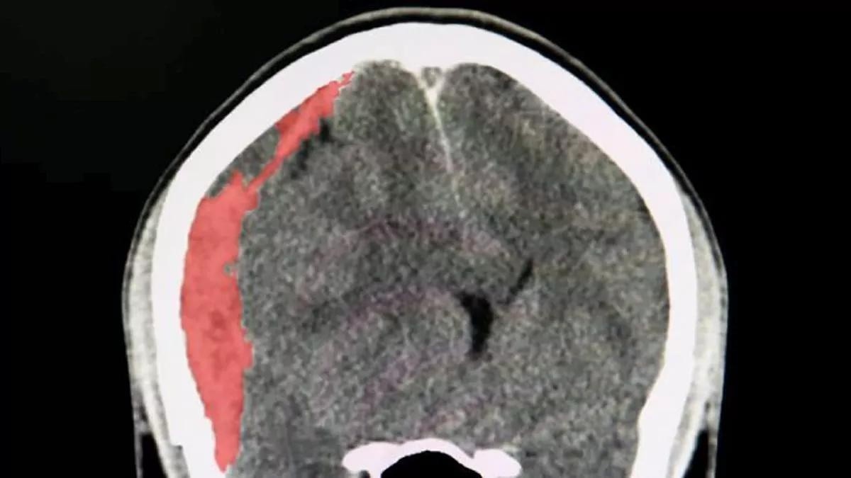 Imagen TAC de un hematoma subdural. (CuidatePlus)